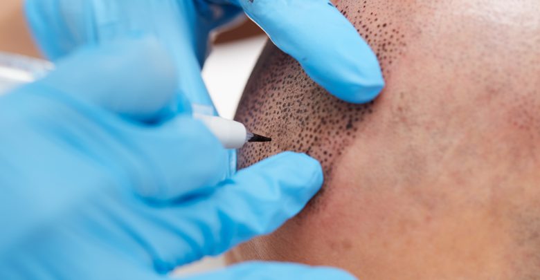 Medical hair tattoo for hair loss