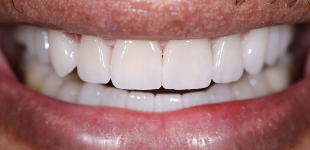 Smile Makeover - Marwan Obeidi Dentist Dubai