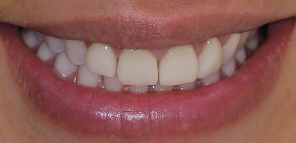 Smile makeover micris
