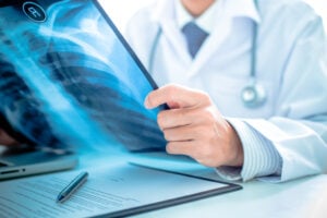lung transplant cost